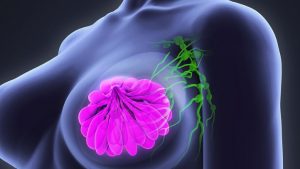 Breast Surgeon in Pune